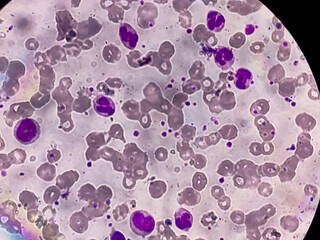 Photomicrograph of hematological slide showing RBC, WBC (Neutrophils and Eosinophil) and platelet. Normal hemogram. CBC
