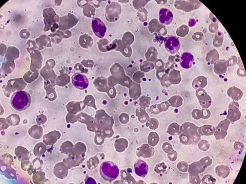 Photomicrograph of hematological slide showing RBC, WBC (Neutrophils and Eosinophil) and platelet. Normal hemogram. CBC