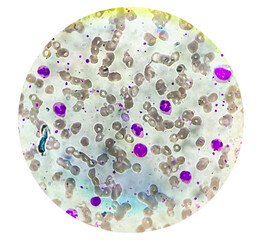 Photomicrograph of hematological slide showing RBC, WBC (Neutrophils and Eosinophil) and platelet. Normal hemogram. CBC