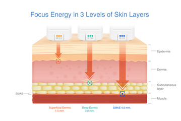 3 Medical devices shoot heat energy to the skin layer at three different depths to SMAS layer. Skin lifting with stimulating collagen and Elastin in skin with Ultherapy and Radio Frequency.