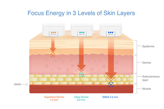 3 Medical devices shoot heat energy to the skin layer at three different depths to SMAS layer. Skin lifting with stimulating collagen and Elastin in skin with Ultherapy and Radio Frequency.