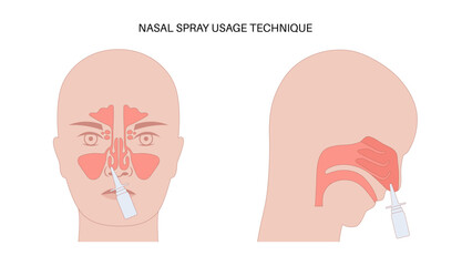 Proper nasal spray usage
