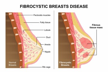 Fibrocystic Breasts Disease Flashcard Illustration