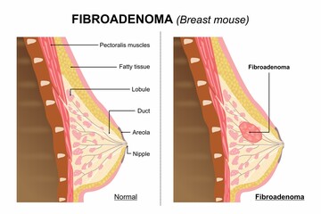 Fibroadenoma (Breast Mouse) Flashcard Illustration