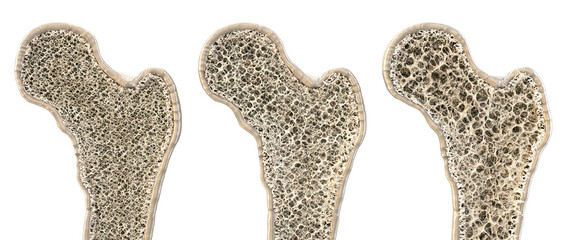 3D cross-section of human bone structure with varying density. Comparison of healthy bone, osteopenia, osteoporosis. Porous trabecular tissue anatomy, skeletal system, medical education, healthcare