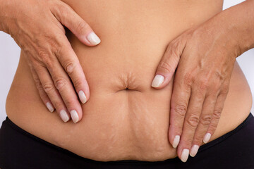 Copped female body with hands on belly with stretch marks