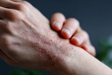 A macro shot of skin with a red rash, symbolizing an allergic reaction or a skin disease like dermatitis or urticaria. Suitable for medical and health-related content.