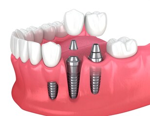 Dental Implant Bridge, Jaw, Teeth, Procedure,  Medical Illustration