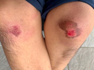 Close-up of a fresh abrasion or scrape on a person's knee, with visible skin damage and redness. A clear representation of a minor injury.