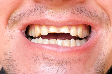 damaged and broken front teeth inside human mouth. Dental health problem, oral hygiene issue, close...