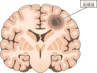 前頭断面_脳腫瘍のイラスト Brain tumor illustration