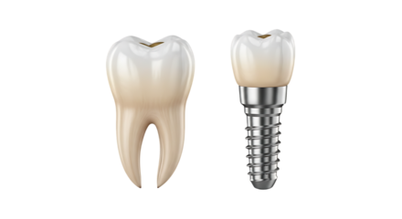 Tooth and dental implant comparison isolated on a transparent background
