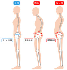 女性　正しい姿勢と猫背と反り腰　背骨と骨盤