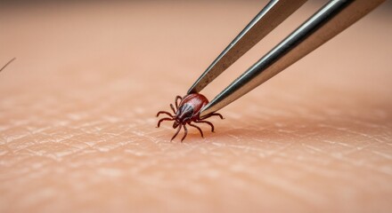 Tick Removal Tweezers extract parasite from human skin macro closeup.