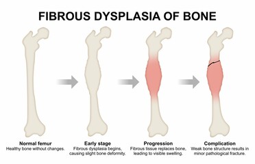 Fibrous Dysplasia of Bone medical flashcard illustration