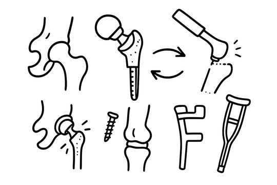 Hip Replacement Doodle. Hand-drawn doodle illustration hip replacement artificial joint, metal implant, hip prosthesis, surgery