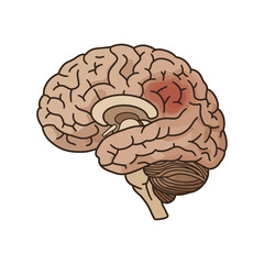 Brain hemorrhage illustration highlighting stroke impact a medical visual ideal for neurology presentations and educational health content on disease
