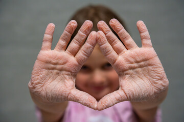 Close-up of a child wrinkled hands after spending a long time in water. Concept of childhood, sensory experience and natural effect of prolonged water exposure.