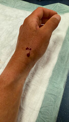 Wound seam body thread medicine