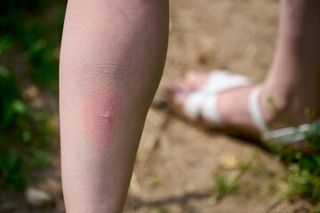 Red mark on leg highlights mosquito bite outdoors