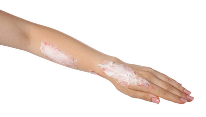 Woman applying healing cream onto burned hand on white background, closeup