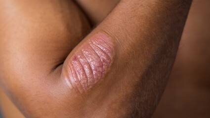 Managing psoriasis symptoms skincare techniques for elbows home health guide close-up wellness strategies