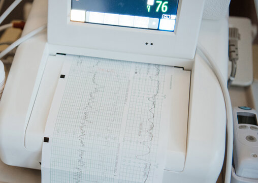 Cardiotocography machine printing fetal data