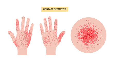 Contact dermatitis poster