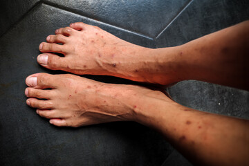 Itchy skin rash and red spots all over a girl's legs and feet. Skin problem, allergy or dermatology concept.
