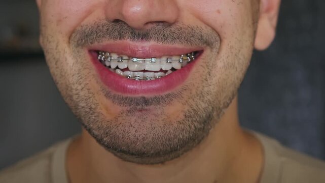 Close-up of a man's smile with braces. Metal braces. No embarrassment. 