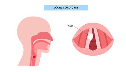 Vocal cord cyst