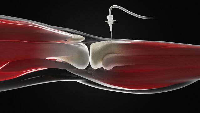 Intraosseous infusion in shin bone, illustration