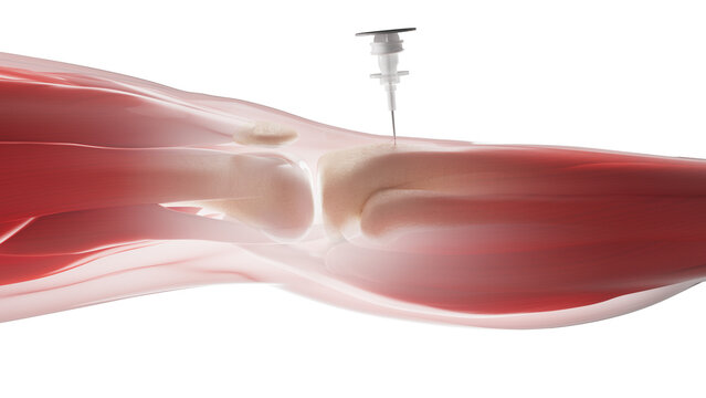 Intraosseous infusion in shin bone, illustration