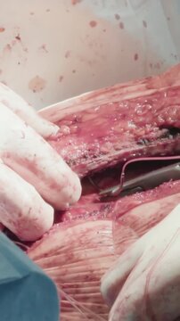 Doctor hands close incision with sutures. Skilled surgical team connects chest after sternotomy ending complicated coronary artery bypass surgery