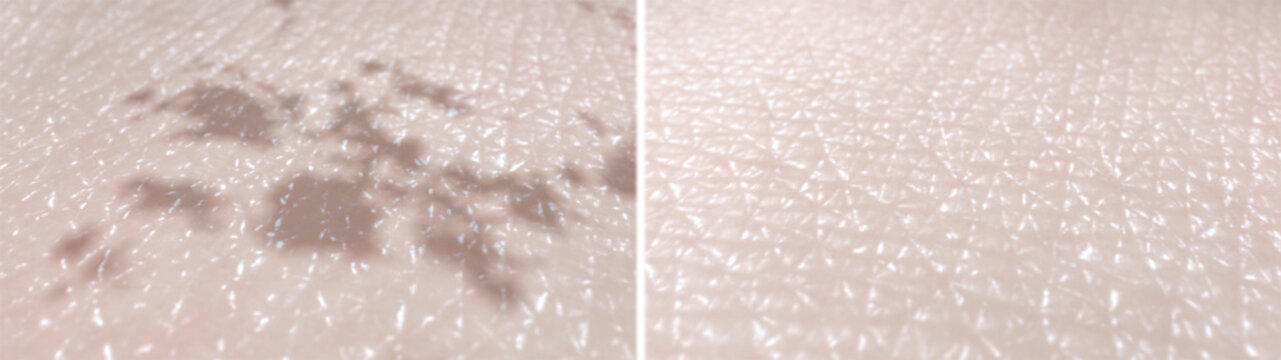 Skin surface before and after the melasma treatment procedure. 3D-rendered illustration showing reduce pigmentation and dark spots after laser therapy, microneedling, chemical peels, or topical creams