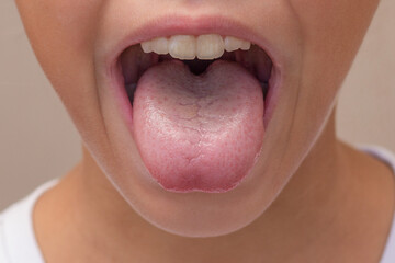 Cropped face of child with tongue with light white coating