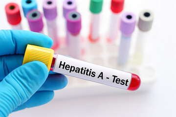 Obraz premium Hepatitis A Test Blood Sample Vial with Medical Examination Laboratory Diagnostics, Healthcare, and Virus Screening