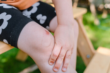 An abrasion and a patch mark on the child's knee outside.