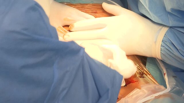 A close-up of a C-section delivery shows a medical team in sterile gowns and gloves carefully assisting the birth of a newborn baby.