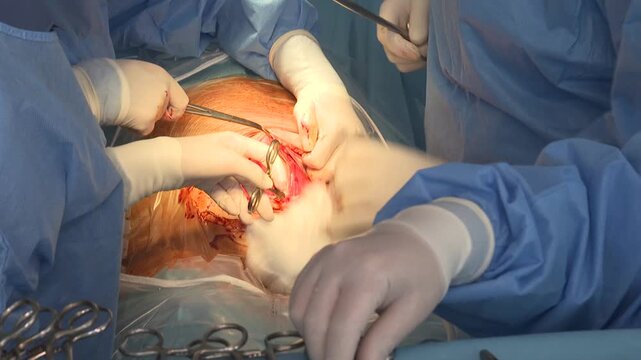 A close-up of a C-section delivery shows a medical team in sterile gowns and gloves carefully assisting the birth of a newborn baby.