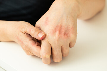 Atopic dermatitis, Allergy, severe allergy. Skin discoloration, Itching of the hands. Medical concept. Healp and treatment. close up