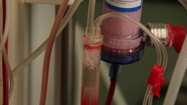 A close-up view of a hemodialysis machine during setup. A person in gloves is carefully connecting tubes to the equipment, which features red and clear tubing, a filter, and various connectors.