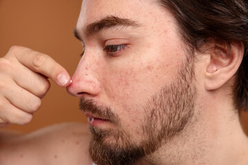 Obraz premium Young man with acne problem applying cream onto his face on brown background, closeup