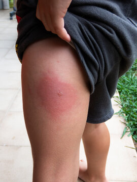 Child showing large red insect bite on leg, lifting shorts