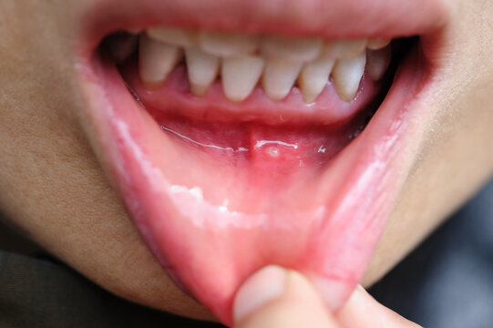 Showing mouth ulcer or canker sore or aphthous stomatitis or aphthous ulcer