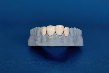 Plaster model of upper jaw with four ceramic veneers placed in front. Concept of cosmetic dentistry, smile design, and dental prosthetics for aesthetic treatment. © Tatiana