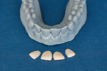 Plaster model of upper jaw with four ceramic veneers placed in front. Concept of cosmetic dentistry, smile design, and dental prosthetics for aesthetic treatment. © Tatiana