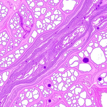 Skeletal muscle atrophy, photomicrograph showing decreased fiber size with increased spacing between them, reduced myofibrils, increased endomysial connective tissue with fatty infiltration