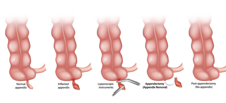 Educational medical illustration showing the stages of appendectomy, including a normal and inflamed appendix, laparoscopic instruments in use, surgical appendix removal, and post-appendectomy state.