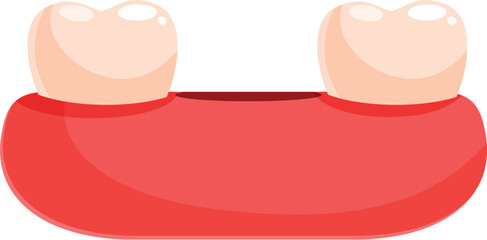 Cartoon illustration of two teeth attached to red gums showing diastema dental problem
